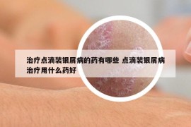 治疗点滴装银屑病的药有哪些 点滴装银屑病治疗用什么药好