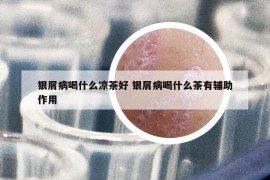 银屑病喝什么凉茶好 银屑病喝什么茶有辅助作用