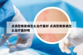 点滴型银屑病怎么治疗最好 点滴型银屑病怎么治疗最好呢