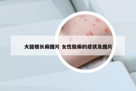 大腿根长癣图片 女性股癣的症状及图片