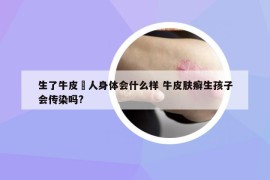 生了牛皮癬人身体会什么样 牛皮肤癣生孩子会传染吗?