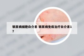 银屑病细胞白介素 银屑病免疫治疗白介素17