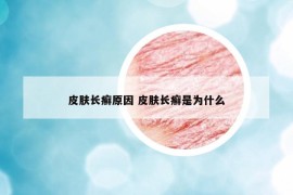 皮肤长癣原因 皮肤长癣是为什么