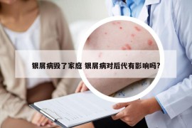 银屑病毁了家庭 银屑病对后代有影响吗?