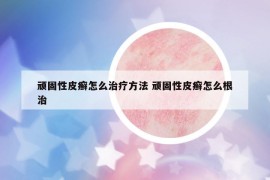 顽固性皮癣怎么治疗方法 顽固性皮癣怎么根治