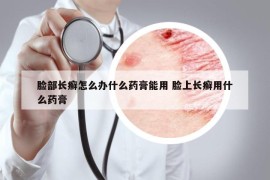 脸部长癣怎么办什么药膏能用 脸上长癣用什么药膏