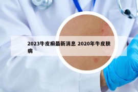 2023牛皮癣最新消息 2020年牛皮肤病