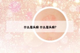 什么是头癣 什么是头癣?