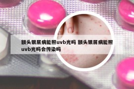 额头银屑病能照uvb光吗 额头银屑病能照uvb光吗会传染吗