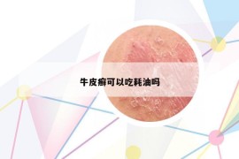 牛皮癣可以吃耗油吗