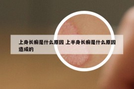 上身长癣是什么原因 上半身长癣是什么原因造成的