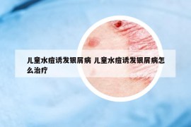 儿童水痘诱发银屑病 儿童水痘诱发银屑病怎么治疗