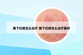 腋下红癣怎么治疗 腋下红癣怎么治疗最好