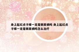 身上起红点子痒一定是银屑病吗 身上起红点子痒一定是银屑病吗怎么治疗