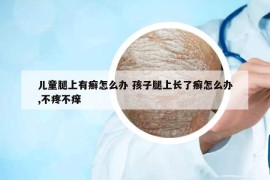 儿童腿上有癣怎么办 孩子腿上长了癣怎么办,不疼不痒