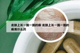 皮肤上长一圈一圈的癣 皮肤上长一圈一圈的癣用什么药