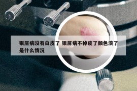 银屑病没有白皮了 银屑病不掉皮了颜色淡了是什么情况