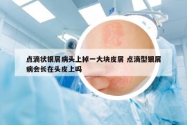 点滴状银屑病头上掉一大块皮屑 点滴型银屑病会长在头皮上吗