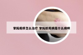 掌跖疱疹怎么治疗 掌跖脓疱病是什么病啊