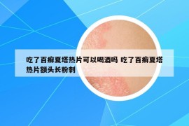 吃了百癣夏塔热片可以喝酒吗 吃了百癣夏塔热片额头长粉刺