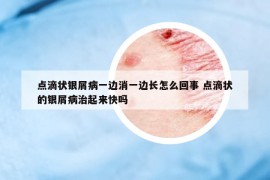 点滴状银屑病一边消一边长怎么回事 点滴状的银屑病治起来快吗