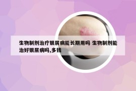 生物制剂治疗银屑病能长期用吗 生物制剂能治好银屑病吗,多钱