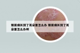 银屑病长到了耳朵里怎么办 银屑病长到了耳朵里怎么办啊