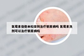 氯霉素倍他米松搽剂治疗银屑病吗 氯霉素洗剂可以治疗银屑病吗