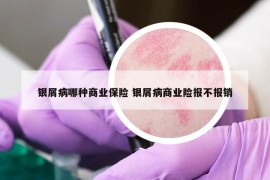 银屑病哪种商业保险 银屑病商业险报不报销