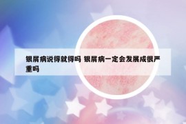 银屑病说得就得吗 银屑病一定会发展成很严重吗