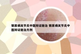 银屑病关节炎中医辩证施治 银屑病关节炎中医辩证施治方剂