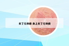 长了几块癣 身上长了几块癣