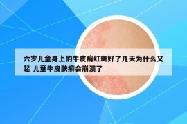 六岁儿童身上的牛皮癣红斑好了几天为什么又起 儿童牛皮肤癣会崩溃了