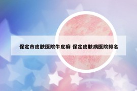 保定市皮肤医院牛皮癣 保定皮肤病医院排名