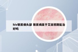 hiv银屑病头部 银屑病属于艾滋初期能治好吗