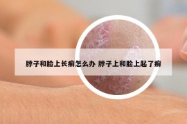 脖子和脸上长癣怎么办 脖子上和脸上起了癣