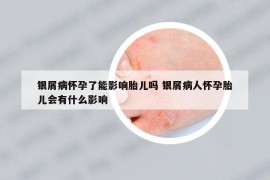 银屑病怀孕了能影响胎儿吗 银屑病人怀孕胎儿会有什么影响