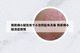 银屑病小腿处有个小包按起有点痛 银屑病小腿消退很慢