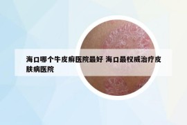 海口哪个牛皮癣医院最好 海口最权威治疗皮肤病医院