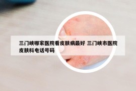 三门峡哪家医院看皮肤病最好 三门峡市医院皮肤科电话号码