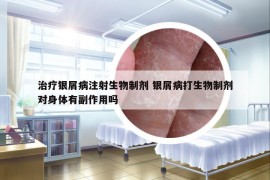 治疗银屑病注射生物制剂 银屑病打生物制剂对身体有副作用吗