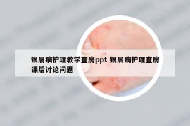 银屑病护理教学查房ppt 银屑病护理查房课后讨论问题