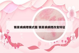 银屑病病理模式图 银屑病病理改变特征