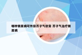 哪种银屑病可外搽芥子气软膏 芥子气治疗银屑病