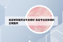 南昌哪家医院治牛皮癣好 南昌专治皮肤病的正规医院