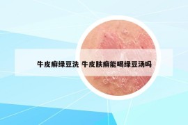 牛皮癣绿豆洗 牛皮肤癣能喝绿豆汤吗