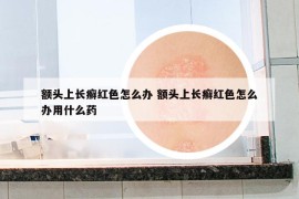 额头上长癣红色怎么办 额头上长癣红色怎么办用什么药