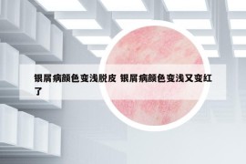 银屑病颜色变浅脱皮 银屑病颜色变浅又变红了