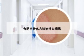 合肥市什么方法治疗白癜风