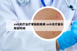 uvb光疗治疗掌跖脓疱病 uvb光疗最长照射时间